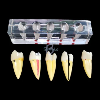 висококачествена эндодонтическая патологична модел на комуникация модел на болестно пациента Эндодонтическое лечение на задните зъби Dentaltool